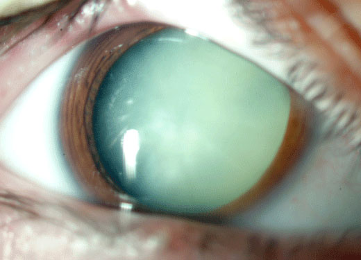 ¿Qué son las cataratas y cómo se forman en los ojos?